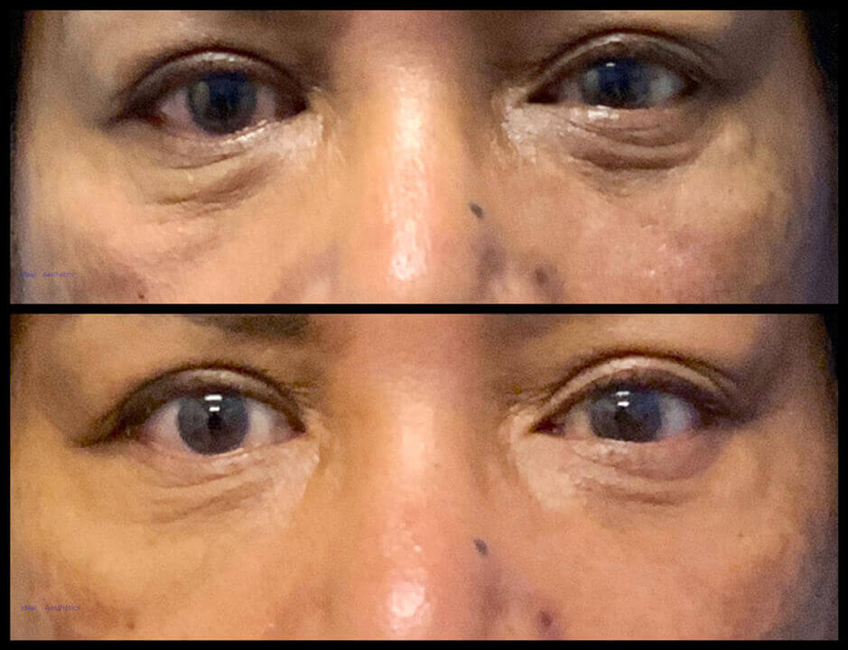 Tear Trough Fillers Before and After