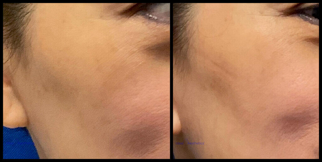 PicoSure Before and After