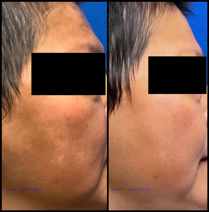 PicoSure Before and After