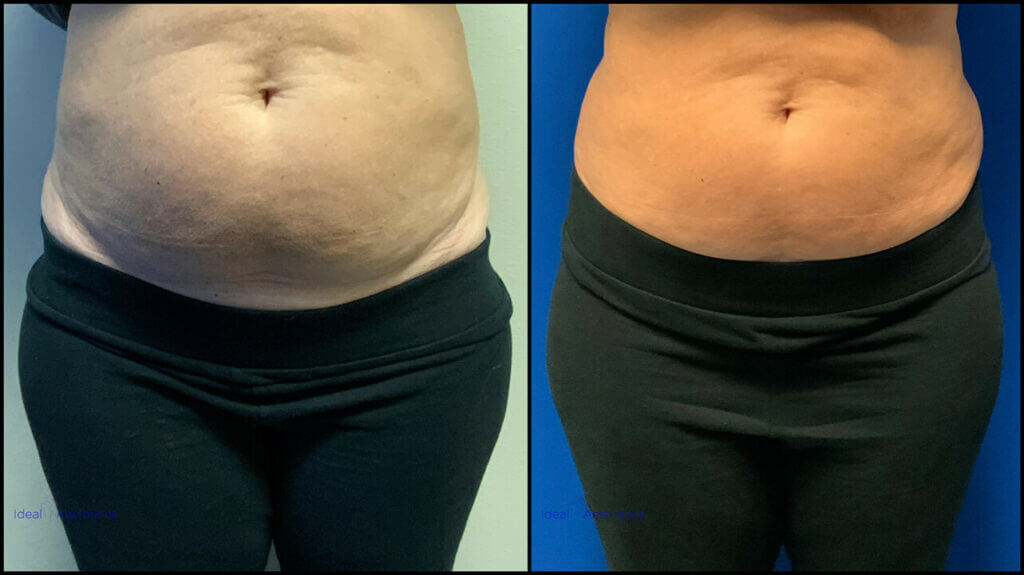 SculpSure Before and After