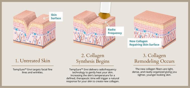 TempSure skin care infographic